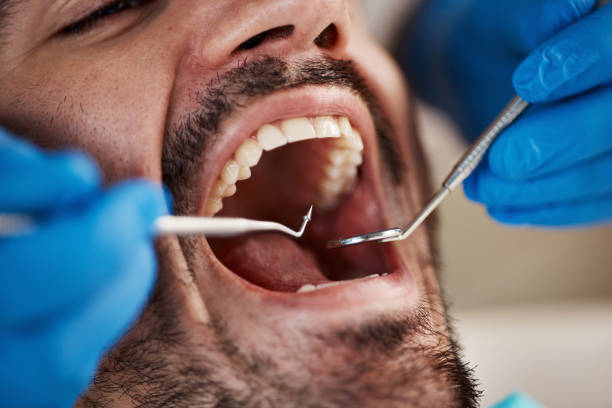 Best Emergency Wisdom Teeth Removal in Adamsville, TN